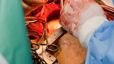 In Arad, medicii i-au extirpat unei femei o tumoare ovariana de 17 kilograme