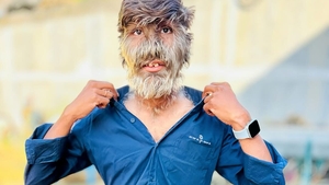 Un adolescent indian este cel mai păros om din lume! Lalit Patidar a intrat în Cartea Recordurilor Guinness