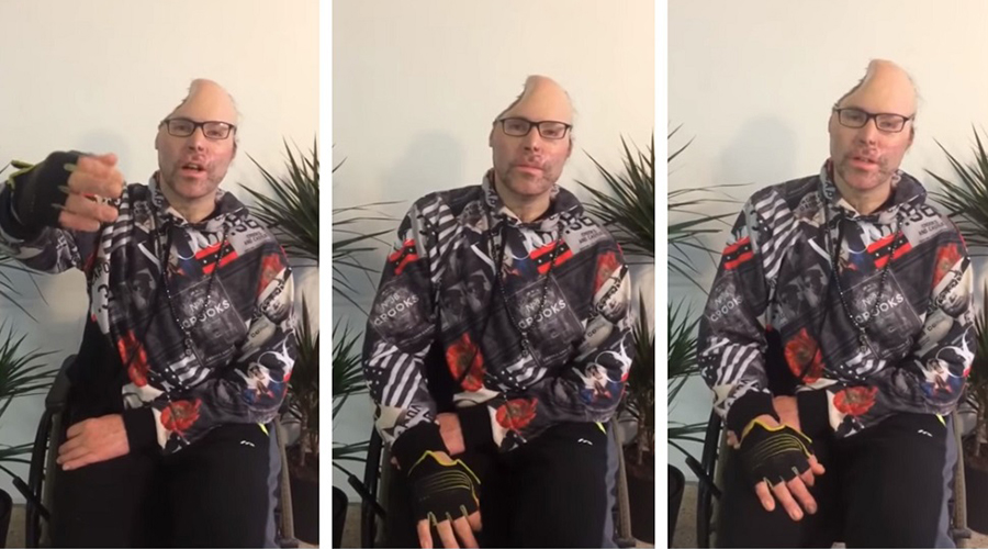Rapper-ul Dr Knarf, paralizat și mutilat și pe viață. Primele imagini după ce medicii i-au îndepărtat jumătate din cap în urma exploziei produsă la un laborator de droguri