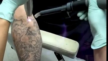 VIDEO ASA se scoate un tatuaj nedorit! Cum arata pielea dupa ce a fost indepartat cu laserul