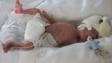 VEZI AICI cum arata doi frati gemeni care s-au nascut la 5 luni si sunt perfect sanatosi