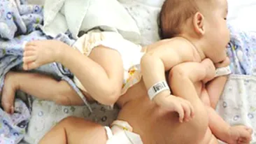 VIDEO Caz rar la Pitesti! Doua fetite siameze au aceeasi inima!