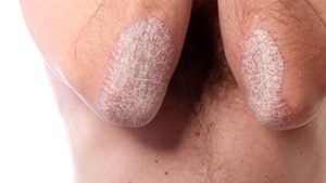 Adolescentii sunt predispusi sa faca psoriazis