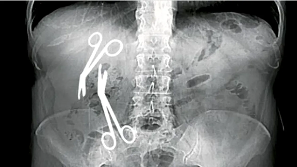 Caz incredibil de grav în Constanța! Un chirurg a uitat două foarfece în abdomenul unui pacient