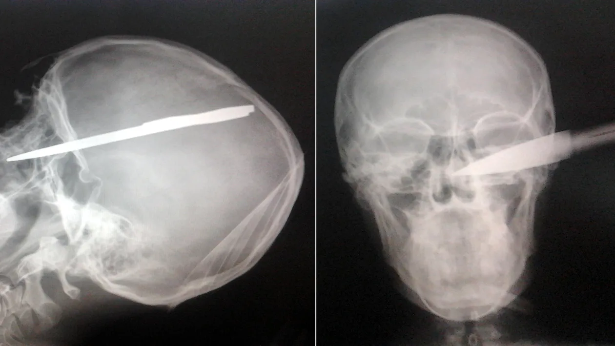 Radiografie socanta! Un tanar a ajuns la spital cu o sabie infipta in cap! A avut un noroc chior si acum e sanatos!