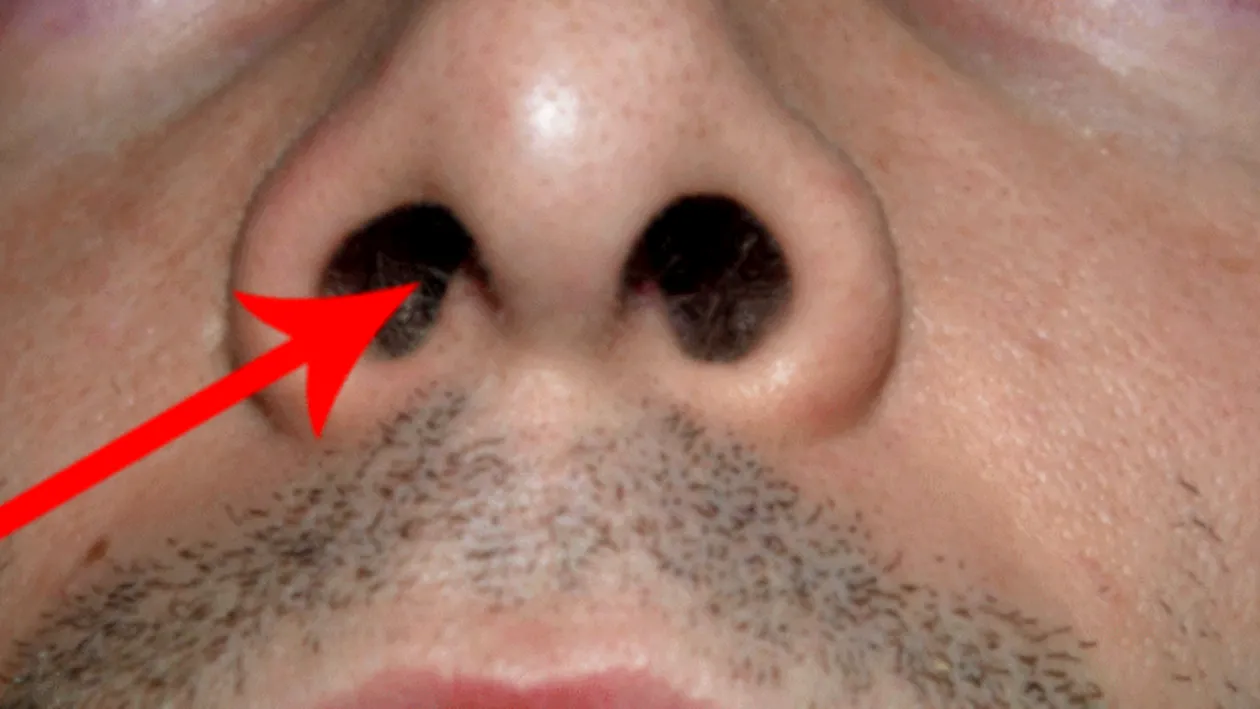 INFIORATOR! Ce au gasit medicii in nasul unui pacient! Timp de 3 ani a avut sangerari abundente si nu intelegea ce i se intampla