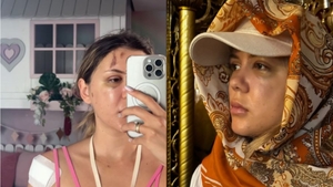Coșmarul trăit de Emily Burghelea de când s-a operat de urgență: „Simt fierul din cap, simt cum se mișcă” VIDEO