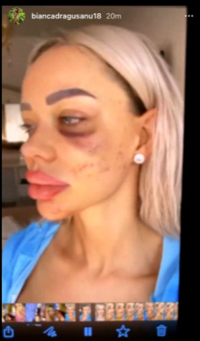 Bianca Drăgușanu desfigurată de fostul soț
