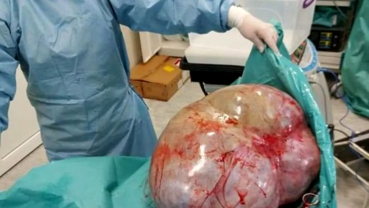 FOTO. Caz incredibil la Botoșani. Tumoare de 24 de kilograme, extirpată din abdomenul unei femei infectată cu COVID-19