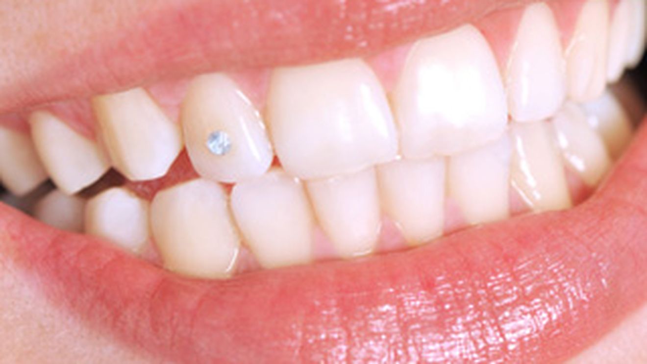 Totul despre bijuteriile dentare