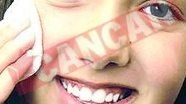 Metode de prevenire a acneei