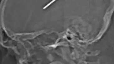 Si-a impuscat un cui in creier! Crezi ca a murit?!