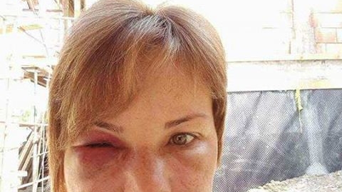Atenţie, imagini cu un puternic impact emotional! A desfigurat-o stomatologul! I-a scos 4 măsele, iar rezultatul este TERIFIANT