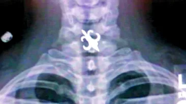 Si-a inghitit cerceii