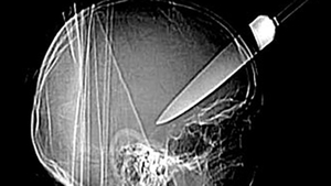 DE NECREZUT! Cu ce a trăit acest bărbat in cap, timp de 10 ani! Medicii au rămas stupefiati când au văzut radiografia