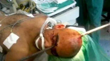 Imagini socante! A supravietuit dupa ce o bara de metal de 2m i-a gaurit capul - VEZI cum a fost posibil