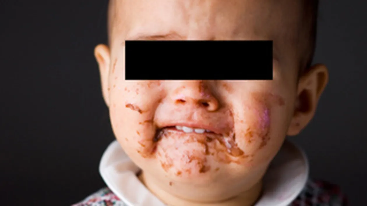 INUMAN! Copil de un an muscat si ars de mama si concubinul acesteia