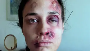 S-a pozat zilnic timp de un an, iar rezultatul e şocant! Transformarea incredibilă a unei tinere bătute de iubit zile in sir