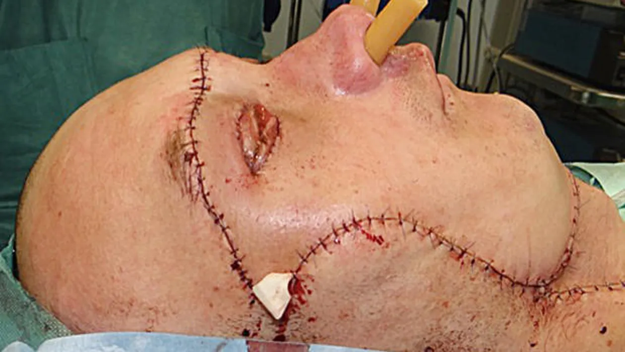 Premieră in lumea medicală! Cum arată omul căruia i s-a făcut primul transplant de faţă din lume