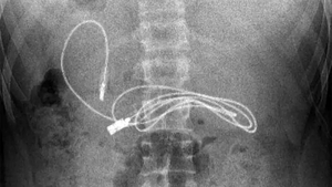 Medicii au crezut că nu văd bine! Ce gadget au putut găsi în stomacul unui adolescent care acuza dureri de burtă