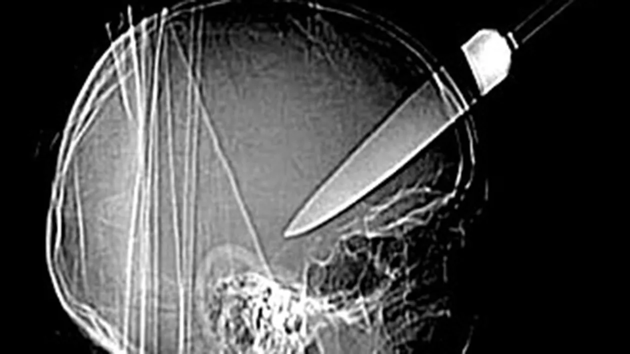 DE NECREZUT! Cu ce a trăit acest bărbat in cap, timp de 10 ani! Medicii au rămas stupefiati când au văzut radiografia