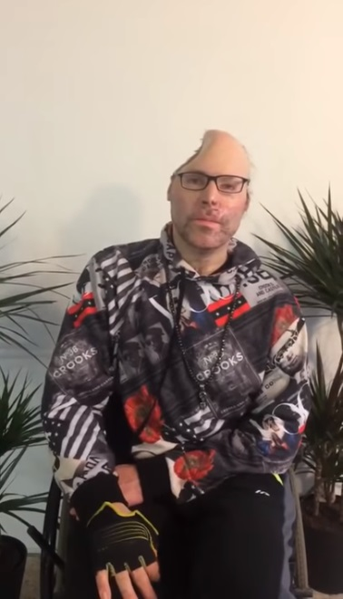 Rapper-ul Dr Knarf, paralizat și mutilat și pe viață. Primele imagini după ce medicii i-au îndepărtat jumătate din cap în urma exploziei produsă la un laborator de droguri