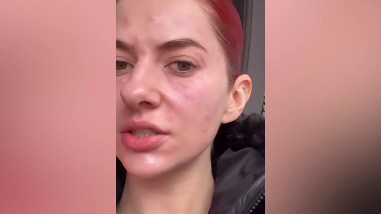 Lidia Buble și-a speriat fanii! A apărut cu fața inflamată și amorțită: „Nu arată rău. Acum e cel mai umflat”