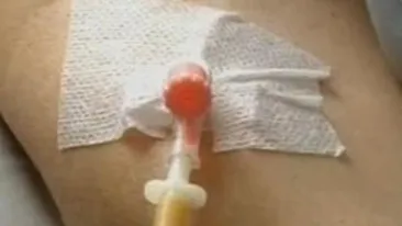 Un tanar din Sibiu a fost muscat de o capusa si acum este suspect de encefalita!