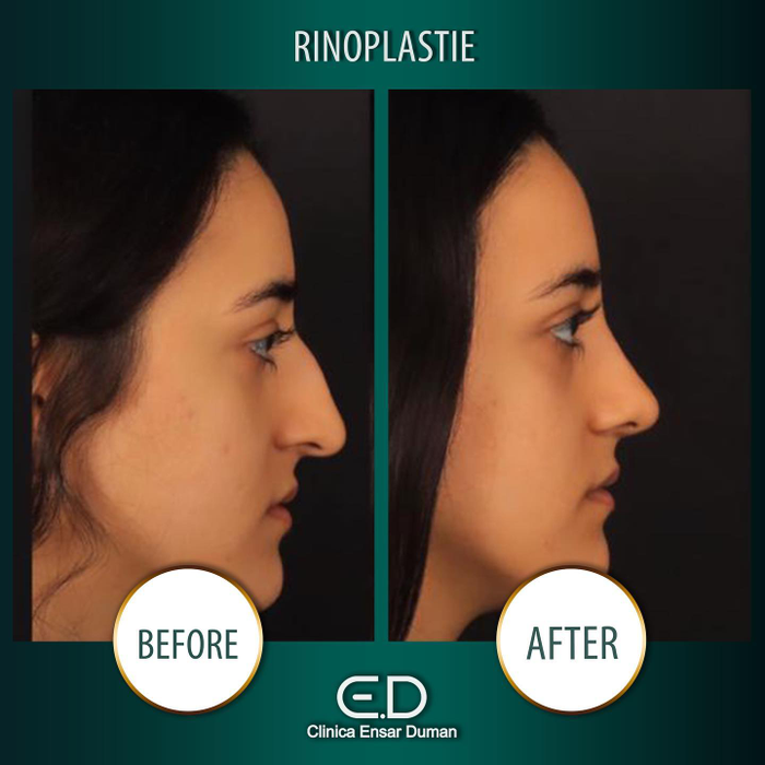 Operația de rinoplastie în Turcia! De ce să alegi pachetele de turism medical când vrei să te operezi la nas