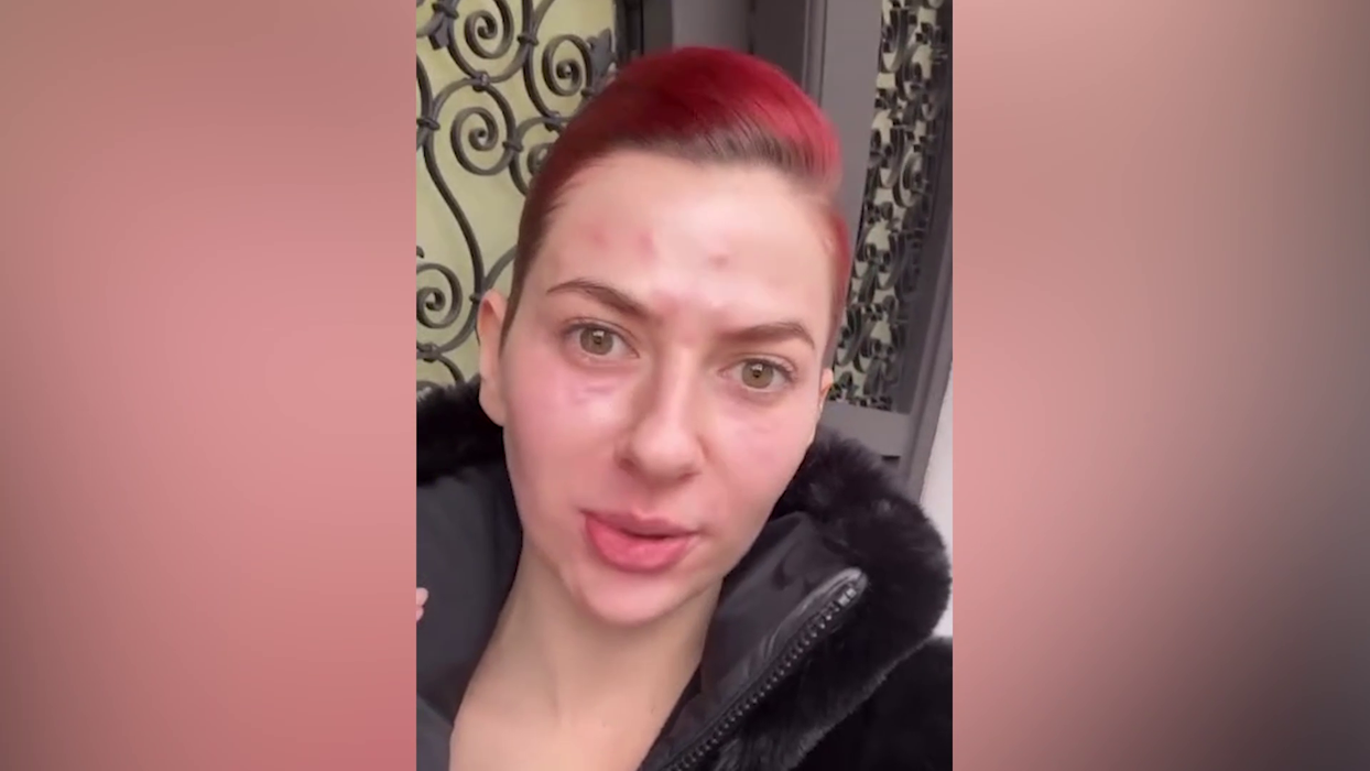 Lidia Buble și-a speriat fanii! A apărut cu fața inflamată și amorțită: „Nu arată rău. Acum e cel mai umflat”