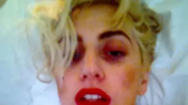 Vezi cum arata Lady GaGa dupa ce a fost lovita pe scena!