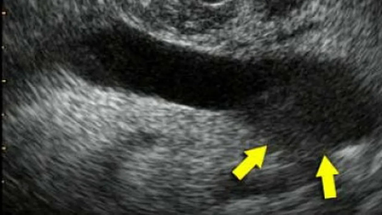 Verdict cutremurator: Un sportiv urias are CANCER si va fi operat de urgenta! Anuntul care a speriat o lume intreaga