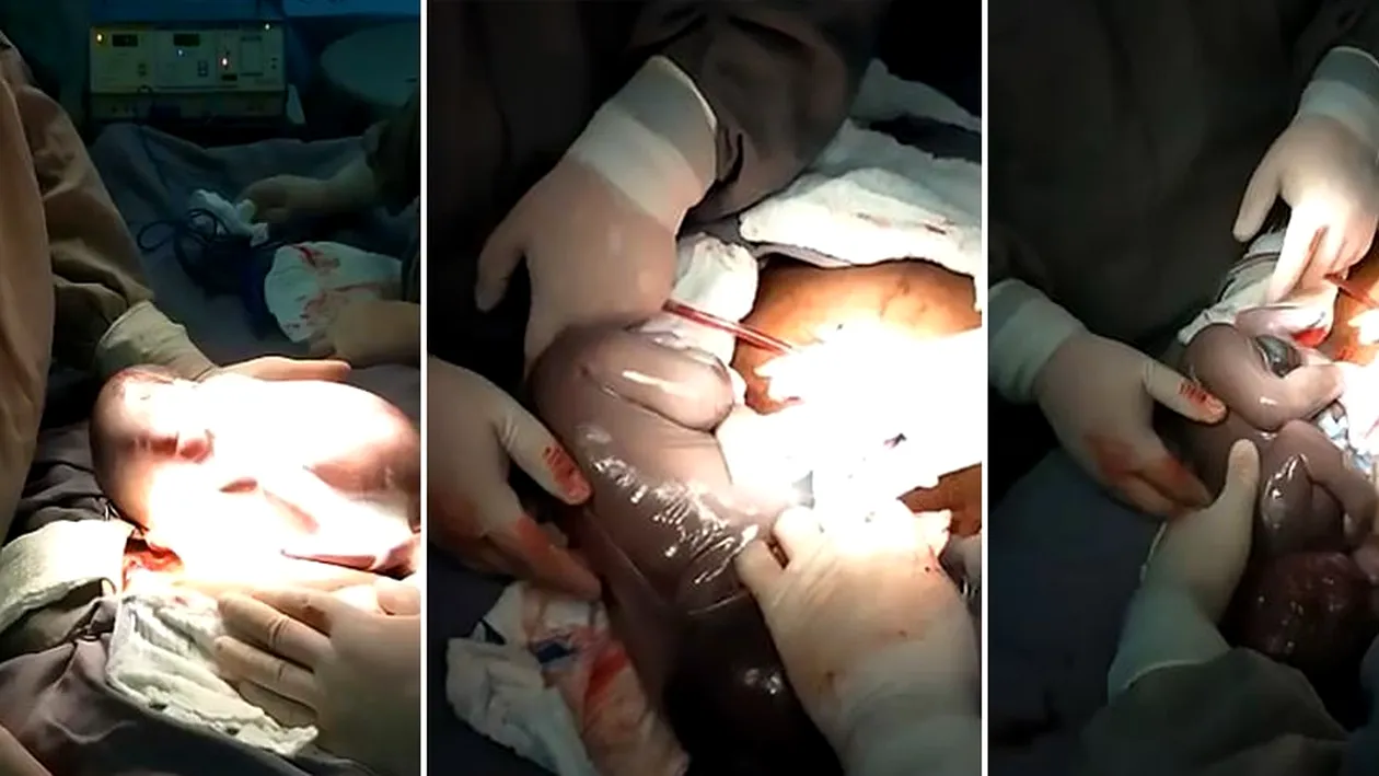 Imagini emoționante în sala de operații: un băiețel s-a născut în timp ce era încă în sacul amniotic. Cazul este foarte rar: 1 la 80.000 de nașteri | FOTO & VIDEO