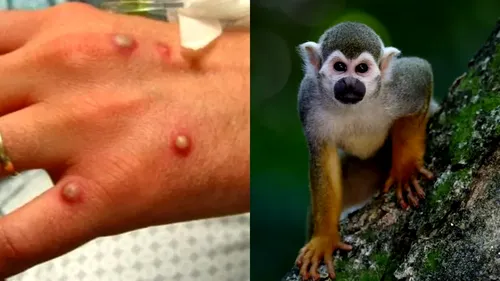 Medicii trag un semnal de alarmă. Cine trebuie să aibă grijă la variola maimuței