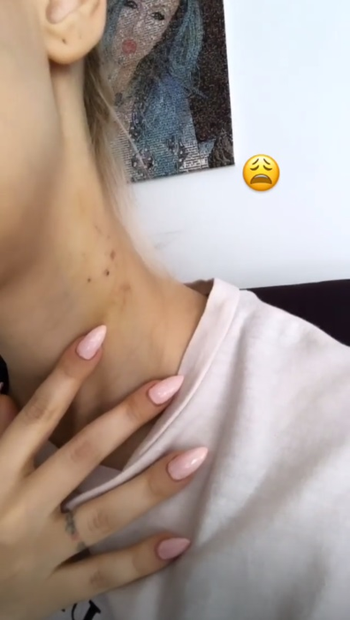 Andreea Bălan, plină de vânătăi. A răbufnit duminică dimineața la ora 10:16: „Aceasta este o poză facută la câteva ore după ce mi-am revenit din stopul cardio-respirator”