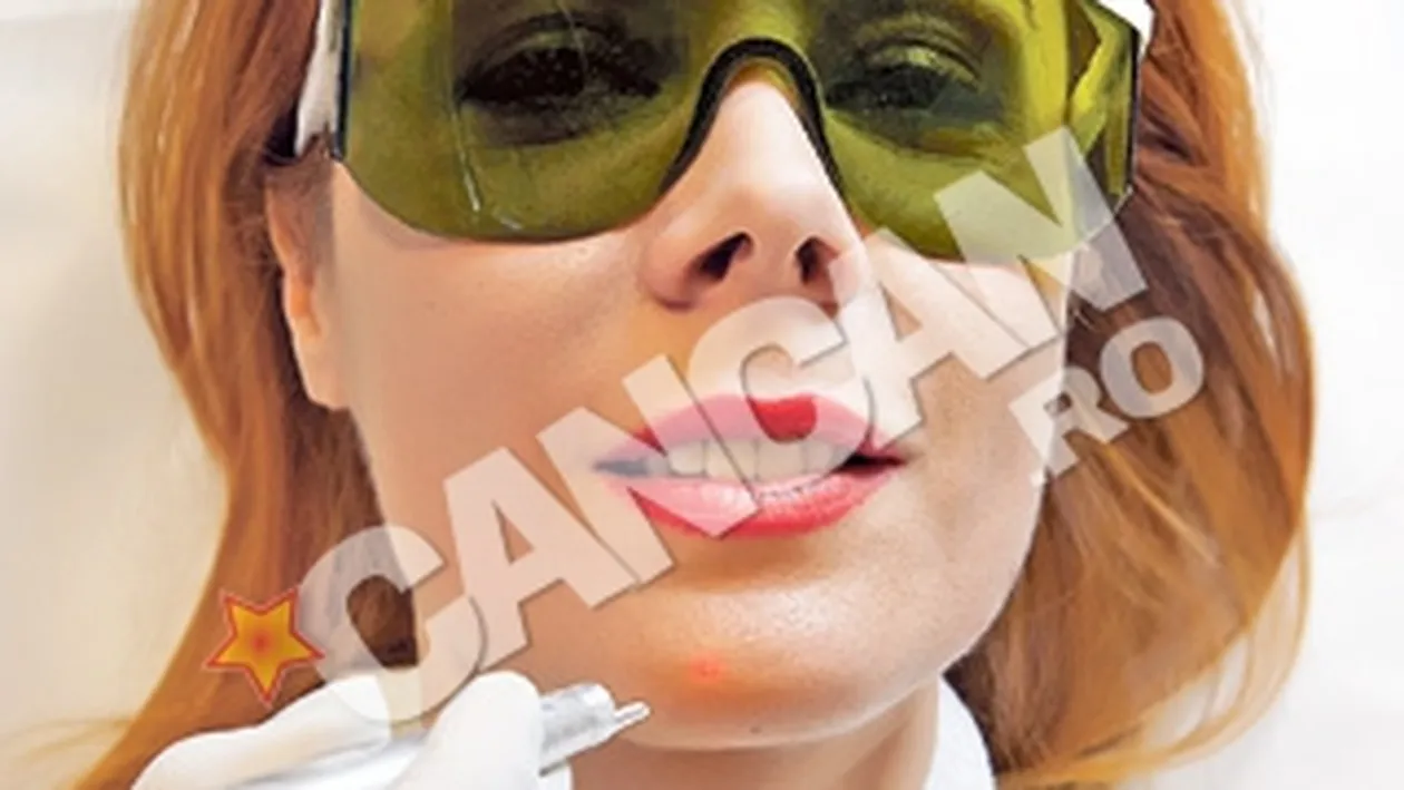 Ultima tehnologie utilizata in intinerirea faciala! Dana Savuica sterge semnele trecerii timpului cu Laser CO2