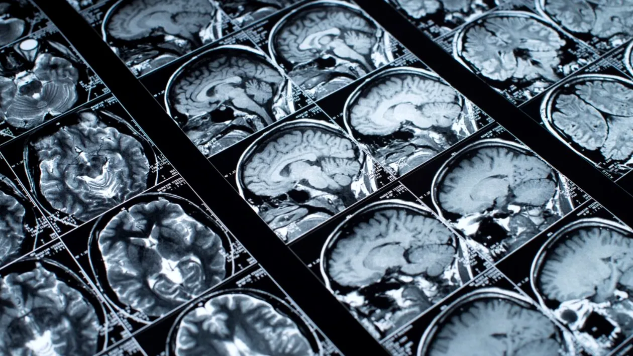 Gestul aparent inofensiv care îți poate dubla riscul de AVC. Majoritatea românilor îl fac fără să știe