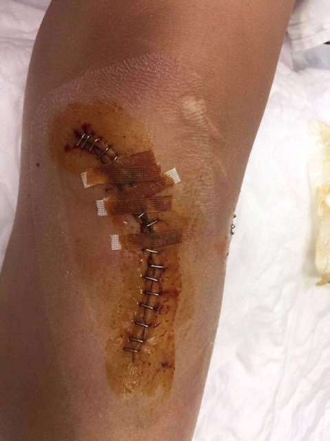 Medicii i-au montat tije în picior lui Dee Dee, în urma accidentului
