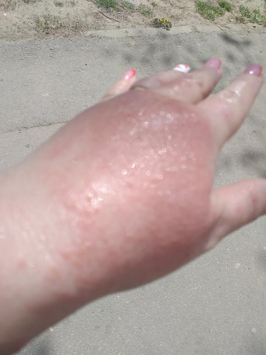 Imagini ireale! Ce a pățit o femeie după ce s-a spălat cu dezinfectant într-un supermarket din Brăila
