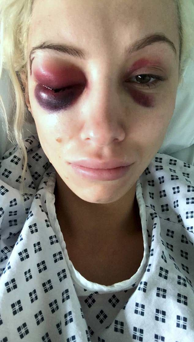 O vedetă bătută și sechestrată de iubit s-a salvat după ce a trimis un selfie cu fața tumefiată
