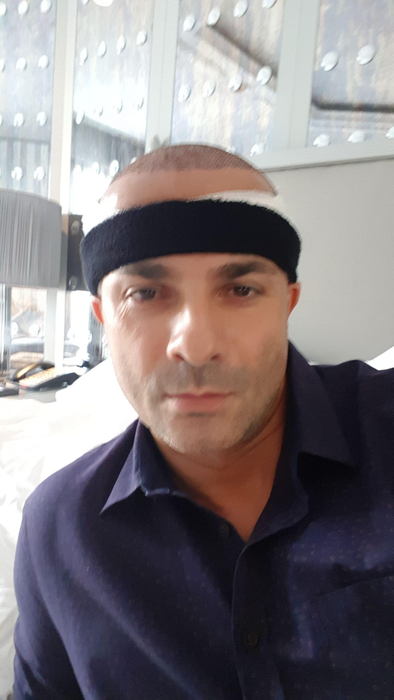 Ești interesat de procedura de implant de păr? Consilierul medical Ensar Duman îți spune ce tehnici noi se realizează în Turcia