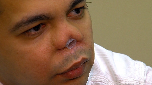 A vrut să arate bine, dar medicul l-a distrus! Cum arată acest bărbat după opt operatii: "Mai bine mor decât să trăiesc asa"