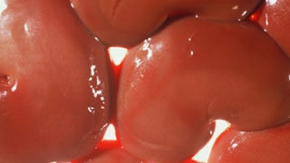 Rinichii romanilor saraci, transplantati ilegal intr-o clinica din Africa de Sud