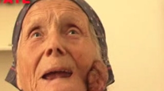O batrana de 91 de ani, operata a doua oara de cancer: "Mi-a aparut o buba pe fata care ma durea si a inceput sa sangereze"