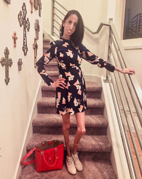 A fost catalogată “cea mai urâtă femeie din lume”, iar acum… Cum arată, în prezent, Lizzie Velasquez