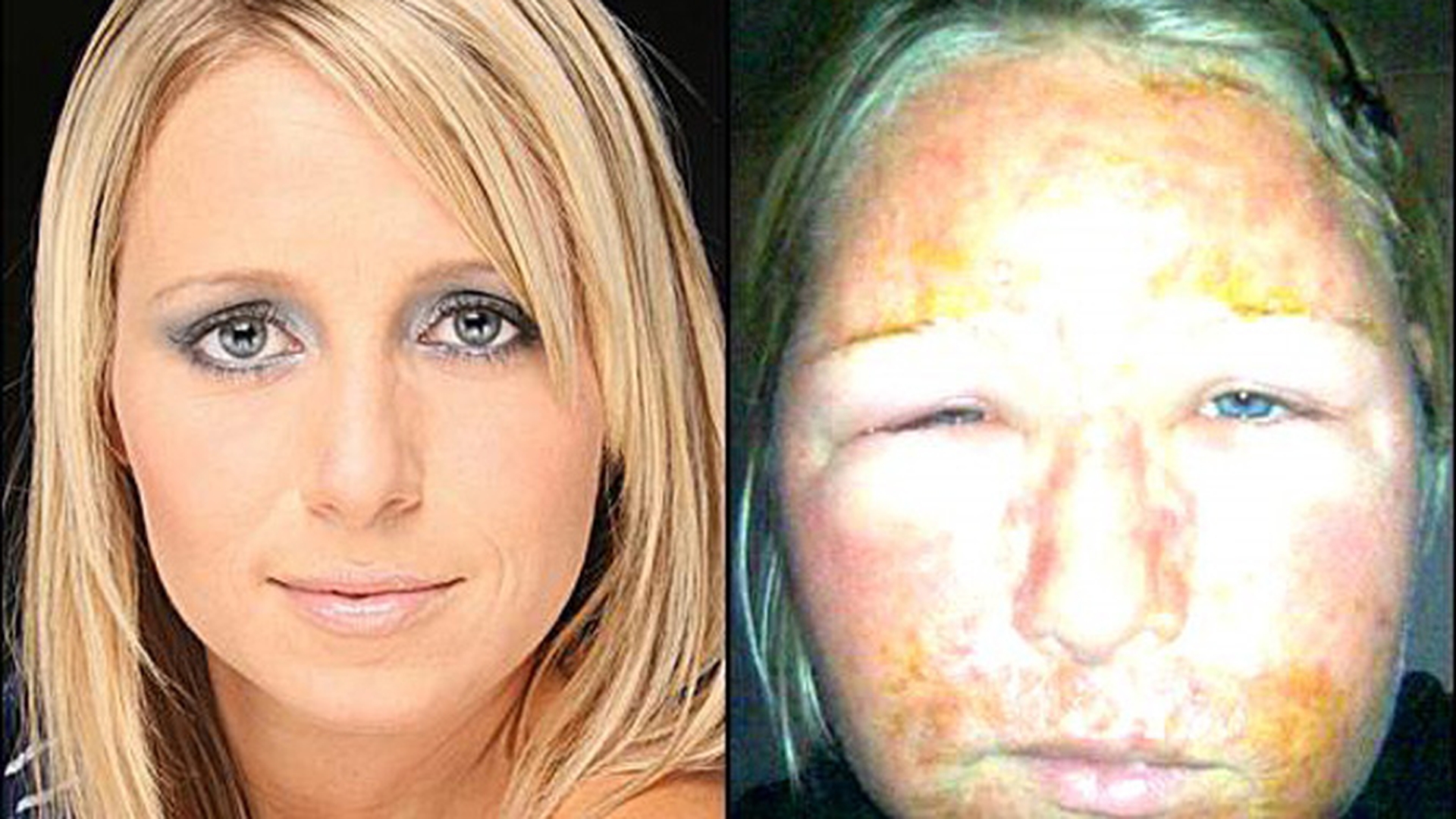 Cu adevarat infricosator! Laurette se poate considera norocoasa. Uite cum a ajuns sa arate aceasta blonda superba dupa un peeling chimic nereusit!