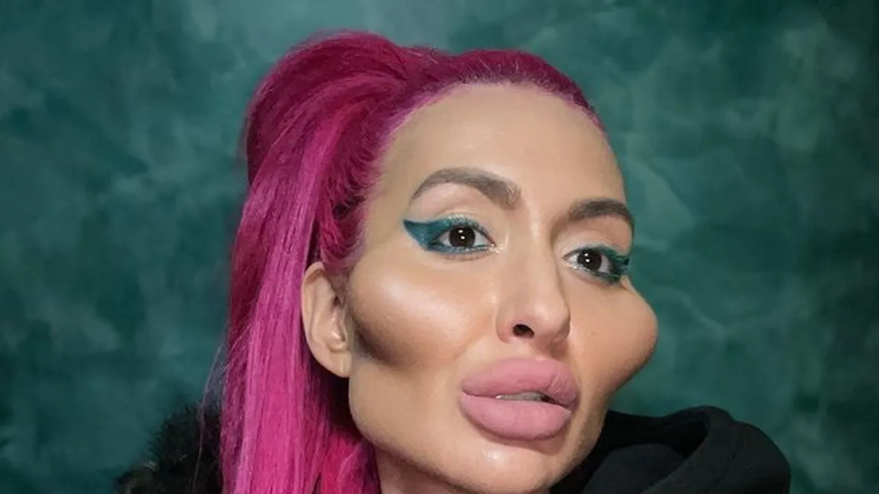 Cum a ajuns să arate o femeie dependentă de botox! Doctorii i-au spus să se oprească