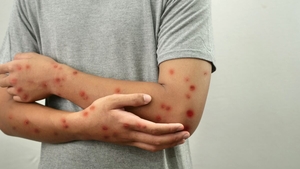 Ce este virusul mpox? A ajuns într-o țară din Europa în care locuiesc o mulțime de români
