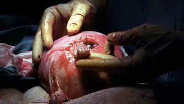 Povestea fotografiei care a impresionat o lume intreaga. Vezi ce mai face baietelul care a strans, din uterul mamei, mana doctorului