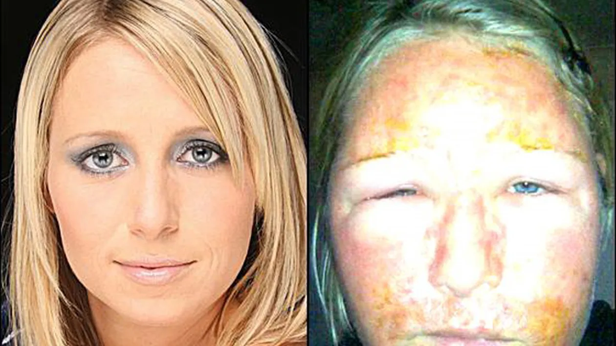Cu adevarat infricosator! Laurette se poate considera norocoasa. Uite cum a ajuns sa arate aceasta blonda superba dupa un peeling chimic nereusit!